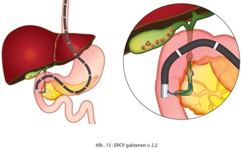 Ercp Maag Lever Darm Stichting