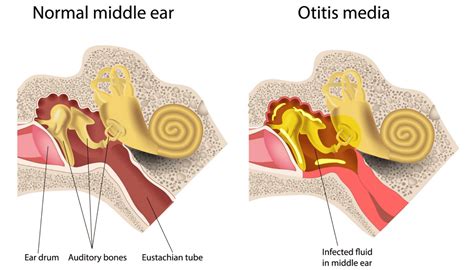 Patient Basics Middle Ear Infection Otitis Media Minute Medicine Hot