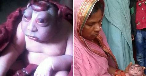 Baby Born With Extremely Rare Deformity Is Rejected By His Mum For Looking Like An Alien