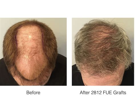 Fue Hair Transplant In Norwood Patient Marc Dauer Md Hair