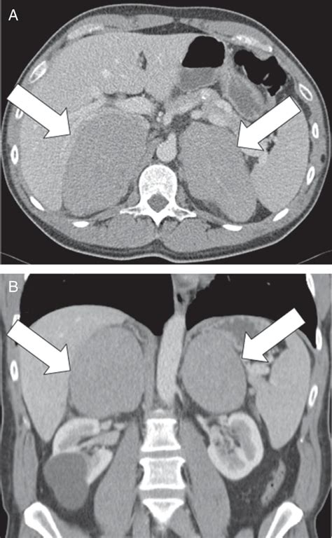 Primary Adrenal Lymphoma Oncohema Key