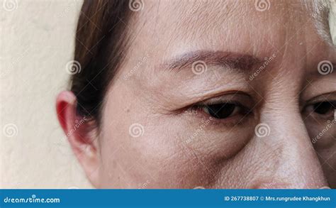 The Flabbiness And Wrinkles Skin Cellulite And Bag Under The Eyes