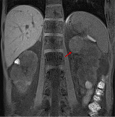 Patient 2 Imaging Mri Of Kidneys Showing Bilateral Neoplasms With The