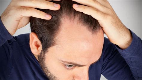 Signs Of Balding Solutions To Hair Loss