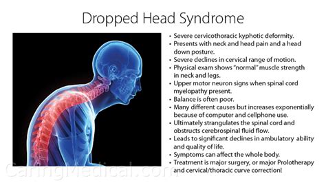 Dropped Head Syndrome Isolated Neck Extensor Myopathy Caring