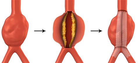 Thoracic Aortic Aneurysm Sydney Endovascular Aneurysm Repair Sydney