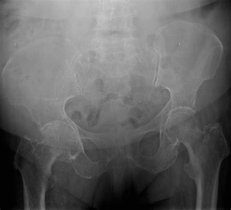 Osteoarthritis Of The Hip Pacs