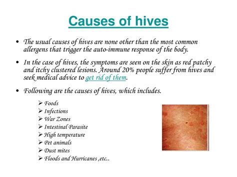 Ppt Hives Treatment Powerpoint Presentation Free Download Id62620