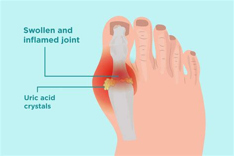 Proper Gout Treatment Should Lead To Lower Uric Acid Crystal Deposits