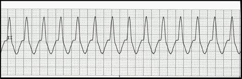 Float Nurse: EKG Rhythm Strip Quiz 201