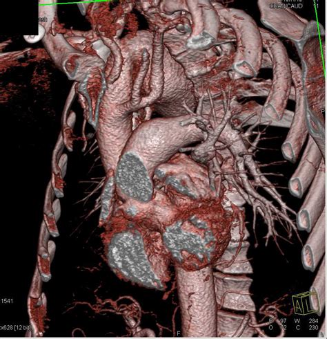 Right Sided Aortic Arch With Ductus Repair Chest Case Studies