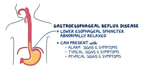 Gastroesophageal Reflux Disease Clinical Sciences Osmosis Video Library