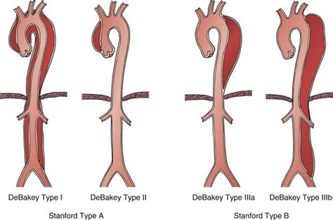 Aortic Dissection Thoracic Key