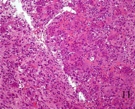 Giant Cell Tumor Pathology Orthobullets