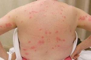 Le médecin peut vous prescrire quelque. Piqure punaise de lit