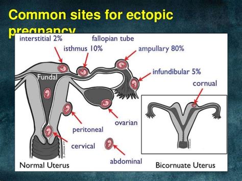 Diagram Showing Sites Of Ectopic Pregnancy Ectopic Pregnancy