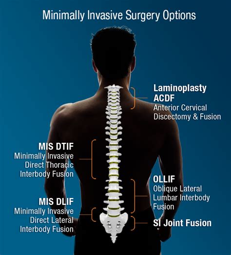 Minimally Invasive Spinal Fusion Doctorvisit