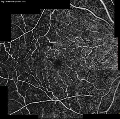 Oct Angiography And Armd