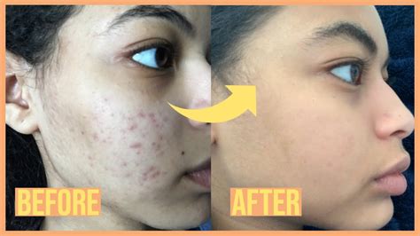 My Accutane Experience Before And After Shams And Reham Youtube