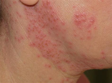 Eczema Herpeticum Symptoms Diagnosis And Treatment