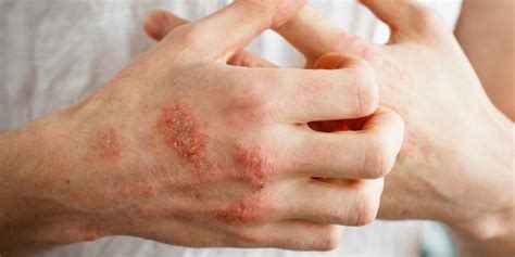 Allergies Cutanées Un Microbiote Altéré Pourrait En être La Cause
