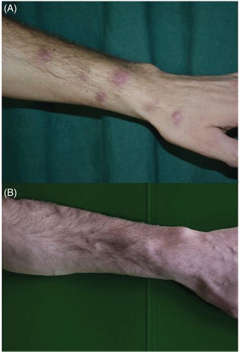 Erythematous Nodules With A Linear Distribution Along Lymphatics On The