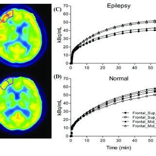 For example, a tumor involving the right side of the brain may affect vision ipsilaterally'that is, in the right eye. Compare the ipsilateral and contralateral regions between ...