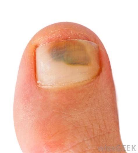 Most cases are caused by a recent mild trauma to the toe and. What Is the Connection between Bruises and Blood?