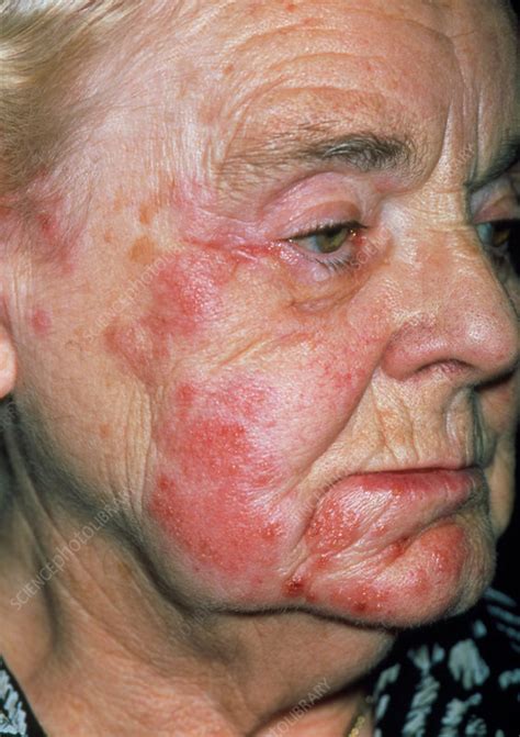 Herpes Zoster Rash On An Elderly Womans Face Stock Image M2600182