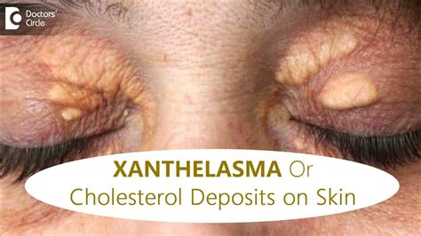 Fatty Deposits Of Cholesterol Around Eyes How To Get Rid Of It Dr