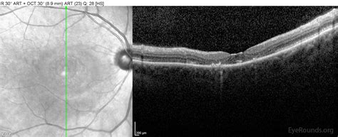 Check spelling or type a new query. Bull's-eye maculopathy due to hydroxychloroquine toxicity