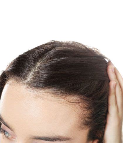 Treating Female Pattern Baldness with Homeopathy | Dr Batra's™