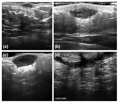 Cureus Hidradenitis Suppurativa At An Uncommon Site A Review Of Its