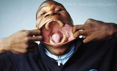 Causes Of Canker Sores Mouth Problems Guiness World Records World Records Mouth Problems