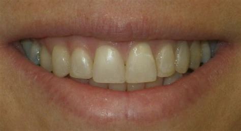 The customized mold covers the space perfectly. Dental Bonding Before & After Photos | Thornhill Dental