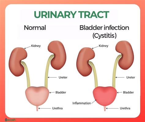 Female Urinary Tract Infection Home Treatment