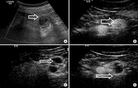 Renal Cell Carcinoma Ultrasound