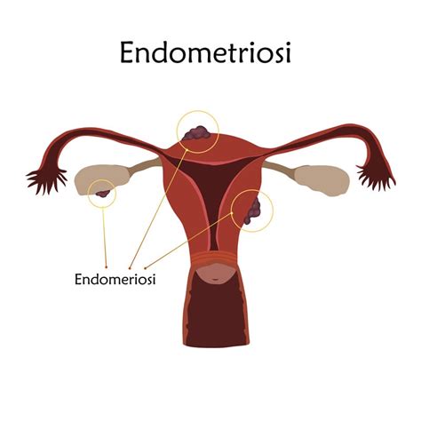 Pelvic exam.during a pelvic exam, your doctor manually feels (palpates) areas in your pelvis for abnormalities, such as cysts on your reproductive organs or scars behind your uterus. Endometriosi - Nostrofiglio.it