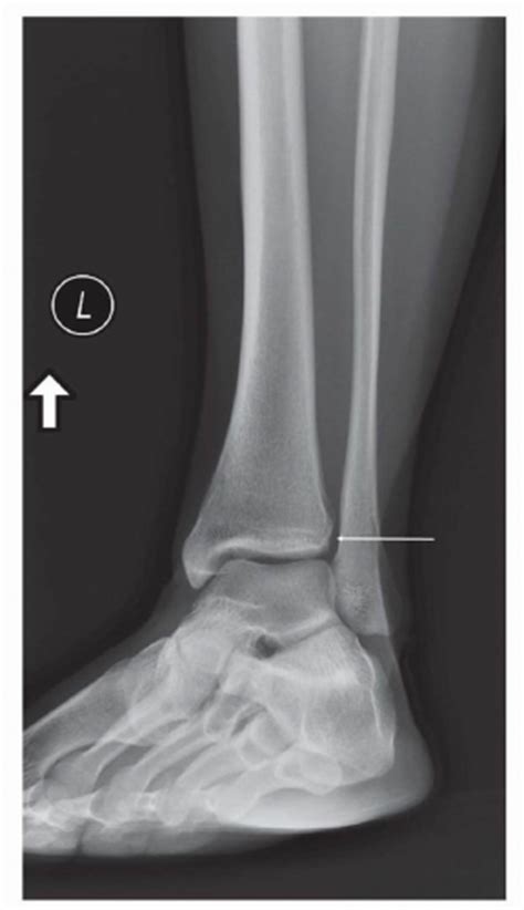 Diagnostic Imaging Techniques Of The Foot And Ankle Musculoskeletal Key