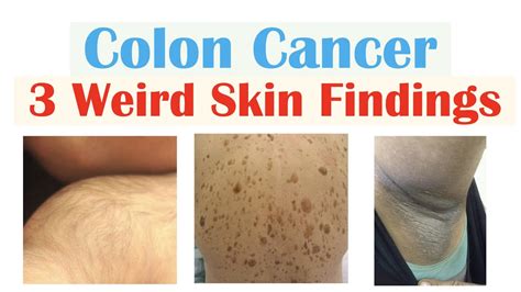 3 Weird Signs Of Colon Cancer Found On The Skin Youtube