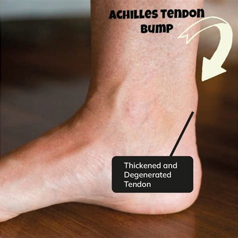 Achilles Tendonitis Treatment For Heel Pain And Symptoms Alleviate
