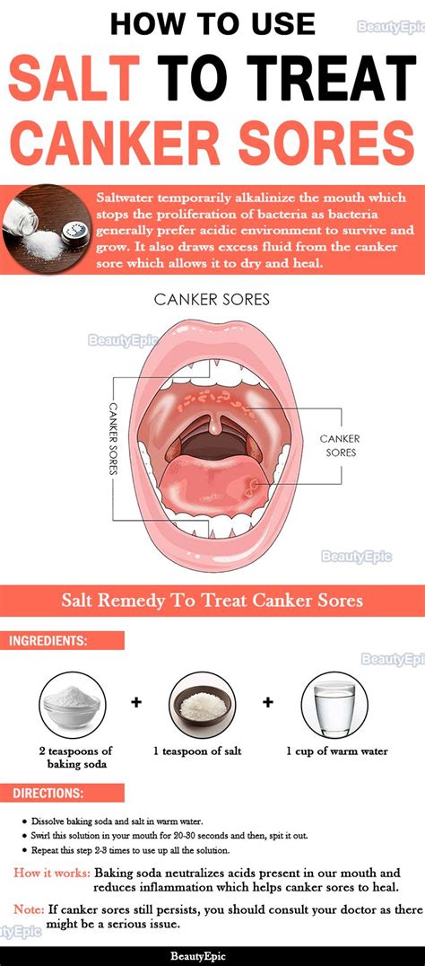 How To Heal A Sore In Your Mouth Tribuntech