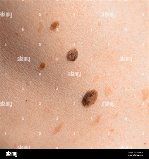 Skin Mole On Human Body Brown Nevi Or Nevus On Back Skin Check Moles