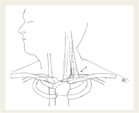 Relevant Anatomical Structures In The Supraclavicular Approach For