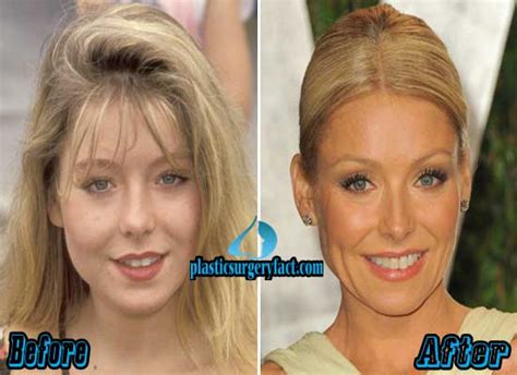Kelly Ripa Plastic Surgery Before And After Pictures