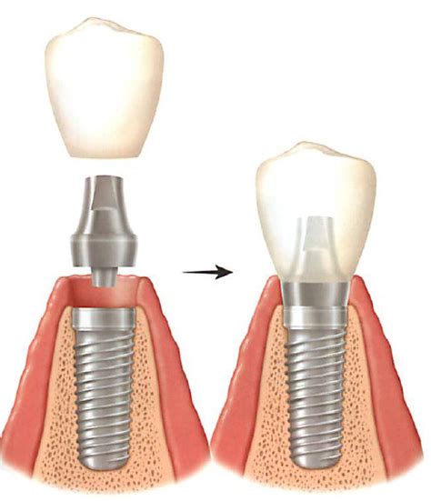 Implant Procedure