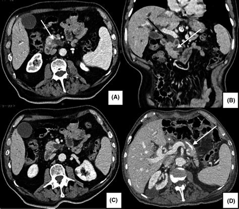 Portal Phase Ct Scans Showing Chronic Pancreatitis With Dilatation Of