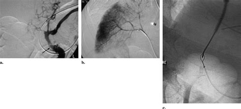 Percutaneous Transsplenic Access In The Management Of Bleeding Varices
