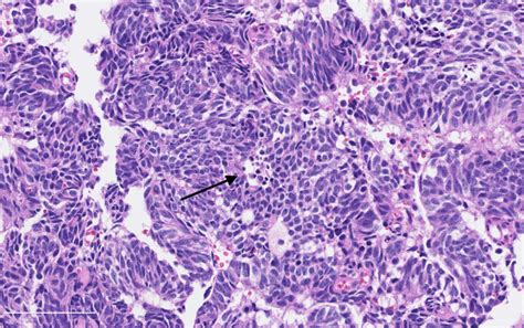 Pathology Outlines Atypical Carcinoid Tumor Neuroendocrine Tumor