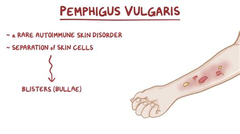 Pemphigus Vulgaris Video Anatomy And Definition Osmosis